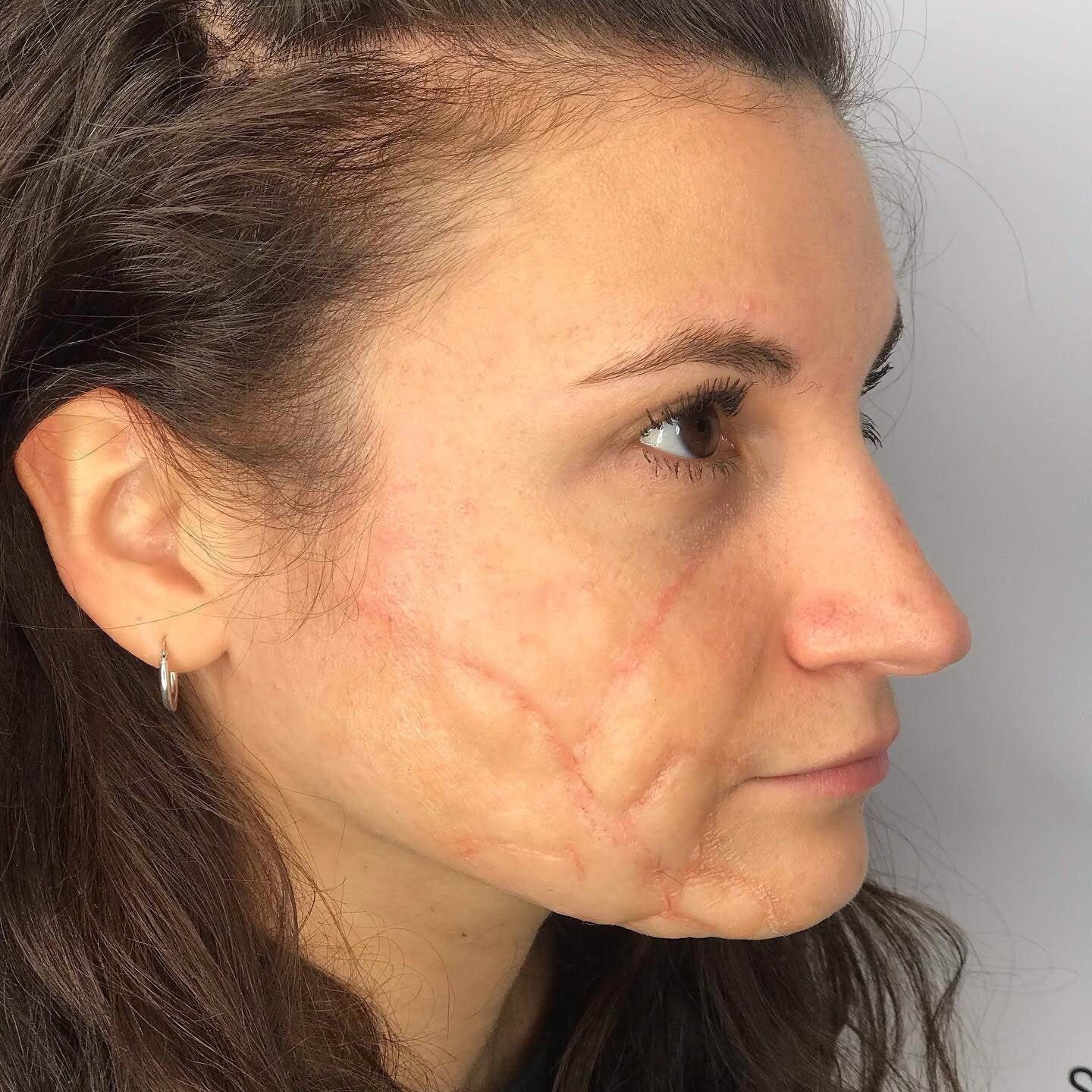Deformed scar