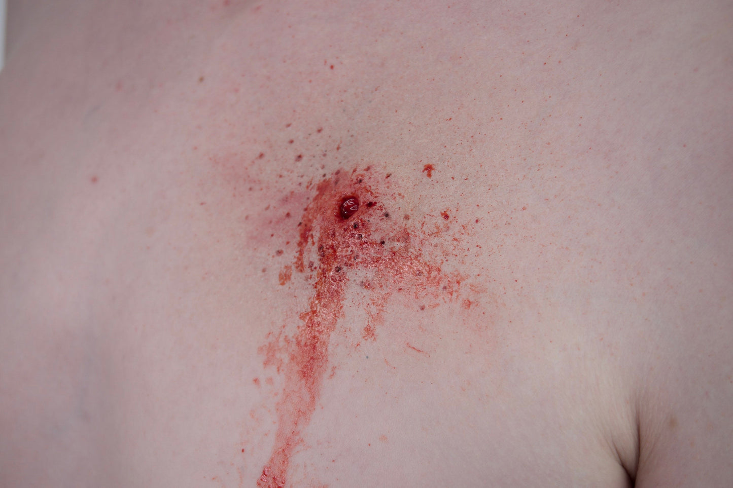 gunshot wound Set - Entry & Exit