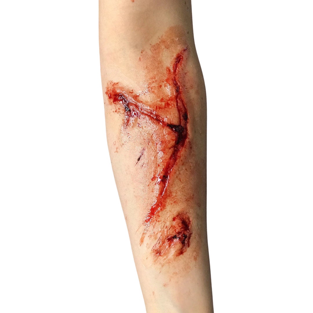 Laceration Wound